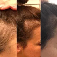 اگه ریزش مو داری قبل از دیر شدن اقدام کن