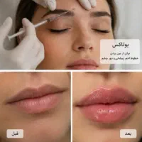 بهترین بوتاکس و فیلر اصفهان/ مشاوره رایگان»