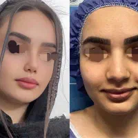 راینوپلاستی )عمل بینی توسط فوق تخصص پلاستیک