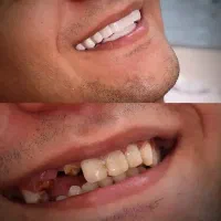 لمینت متحرک دندان