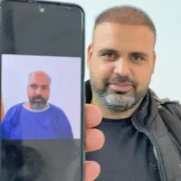 کاشت مو کاشت ابرو