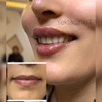ژل بوتاکس مزو
