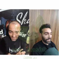 کاشت ابرو ، مو و ریش ( ضمانت نامه کتبی )