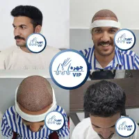 تخصصی ترین مرکز کاشت مو در ایران