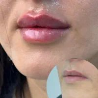 بوتاکس ۸۹۰فیلر ۹۸۰ پی ارپی ۸۹۰ انواع مزو۱۲۷۰