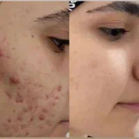 کرم ملکه بهترین کرم با سابقه چهار سال فروش