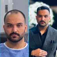 جشنواره کاشت مو طبیعی با تراکم بالا ( یک روزه )