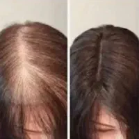 برای رشد ریش و مو بیا