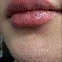 به مدت محدود  فیلر لب و صورت فقط ۱ تومن در مطب