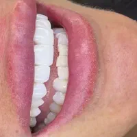 کامپوزیت 10م توسط دندانپزشک ،عصب کشی باپرکردن 3000