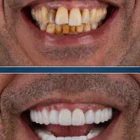 ایمپلنت فوری با روکش رایگان((اقساطی ویژه))
