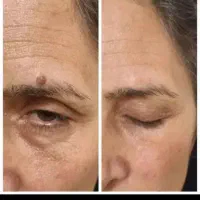 برداشت خال های گوشتی برجسته