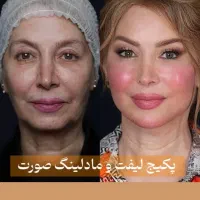 کمبو تکنیک  سانترال لب بدون جراحی   لبخند لثه ای