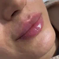 بوتاکس صورت زیربغل فیلر مزوتراپی مو لاغری پی آر پی
