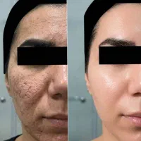 پاکسازی پوست با بروزترین دستگاه ها(آقا وخانم)
