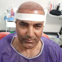 مشاوره رایگان قبل از کاشت مو