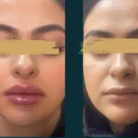 آموزش فیلر و بوتاکس و مزوتراپی و جوانساز