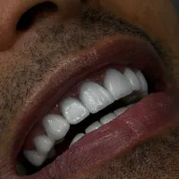 کامپوزیت لب ساده واحدی ۴۵۰۰ لب شفاف فقط واحدی ۶۵۰۰