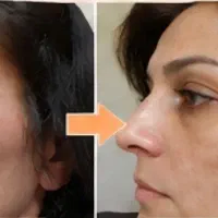 رفع لک پوست با کرم بیوممتیک تحویل ۱ روزه