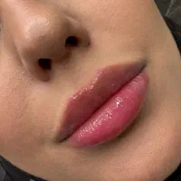 تزریق فیلر لب عروسکی/مادلینگ صورت 670هزار