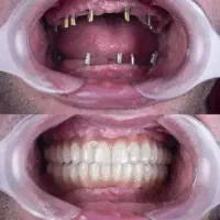 اقساط ویژه ایمپلنت در مرکز تخصصی دندانپزشکی تبریز