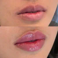 تزریق ژل و بوتاکس و انزیم،نصیراباد
