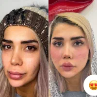 تزریق فول‌ فیس،ژل لب، بوتاکس،لب روسیM،فیلر بدن