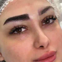 کاشت مو و ابرو