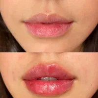 مطبِ بوتاکس ژل لب گرگان