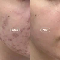 فول فیس نچرال با تخفیف ویژه،فیلر،بوتاکس،مزوژل