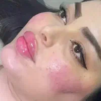 تزریق ژل و بوتاکس.جوانساز.انزیم داخل مطب