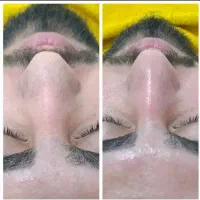 فیشیال فوق تخصصی جوانسازدرمانی (خانمها وآقایان)