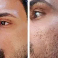 مدل رفع کک و مک/مزونیدلینگ/ جوش/جای جوش/میلیا