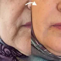 رفع چروک صورت
