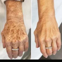 پوستتو جوون کن تضمینی