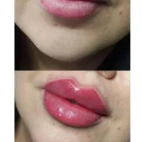 فیلر ، ژل و بوتاکس|خدمات آرایشگری و زیبایی|رباط‌کریم, |دیوار