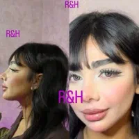فیلربادی/کانتورینگ۴/بوتاکس ۳۵۰/کاشت مو/ژل لب