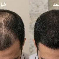 جلوگیری از ریزش و رویش مجدد مو|آرایشی، بهداشتی، درمانی|دزفول, |دیوار
