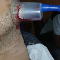 حجامت.زالو درمانی. فصدخون.طب سوزنی