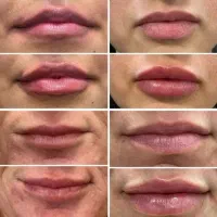 تزریق ژل لب، بوتاکس و زاویه‌سازی  قیمت مناسب