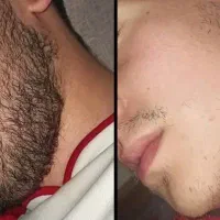 رویشی دوباره،پرپشتی ریش ومو