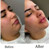 تزریق فیلر بادی تزریق چربی صورت تزریق ژل و بوتاکس