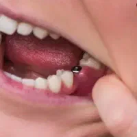 مرکزفوق تخصصی ایمپلنت دیجیتال/بدون درد/روکش فوری