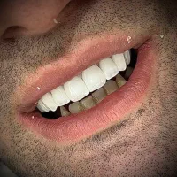خدمات دندانپزشکی روکش تمام سرامیکی زیرکونیا ۶/۷۰۰