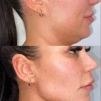 ژل لب ۶۰۰بوتاکس۸۰۰کانتورینگ صورتت تخفیف ۵۰٪