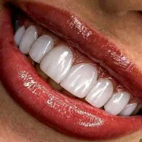 جشنواره کامپوزیت ونیر لمینیت روکش عصب ترمیم IMAX