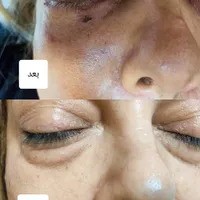 رفع چروک زیر چشم/رفع پف زیر چشم