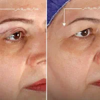 پی آر پی/بلفاروپلاستی/جوانساز/تزریق چربی/جشنواره