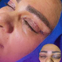 جشنواره بلفاروپلاستی(فقط ۷،۸۰۰)