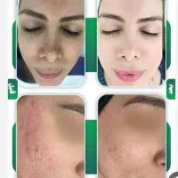 کاربرد لیزر کیوسوئیچ